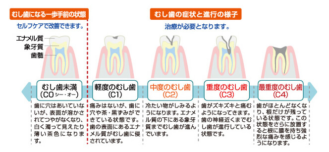 虫歯の進行の図