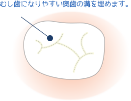 シーラント塗布のイラスト